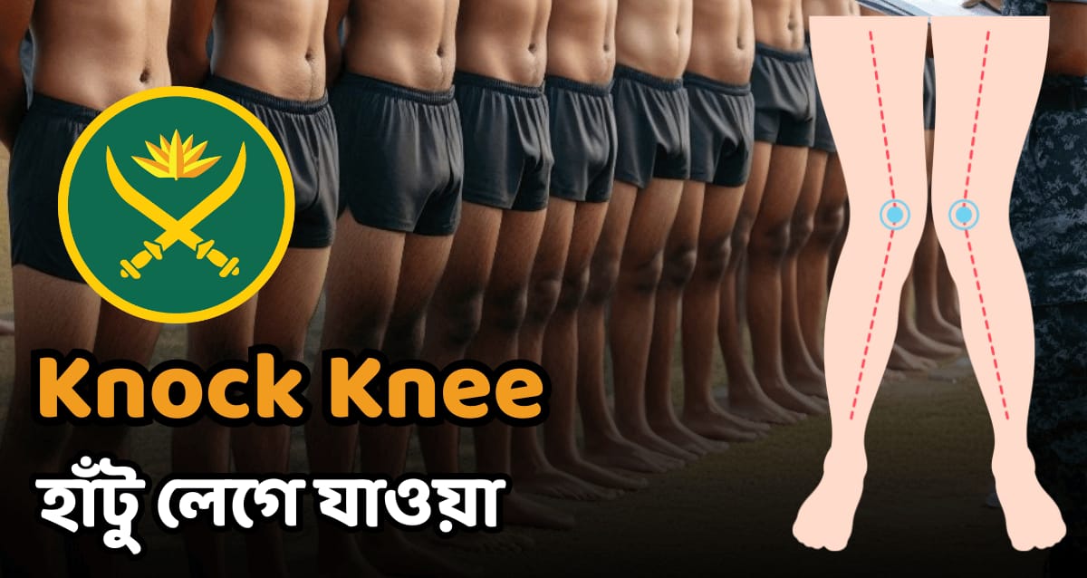 দুই হাটু লেগে যাওয়া সমাধান
